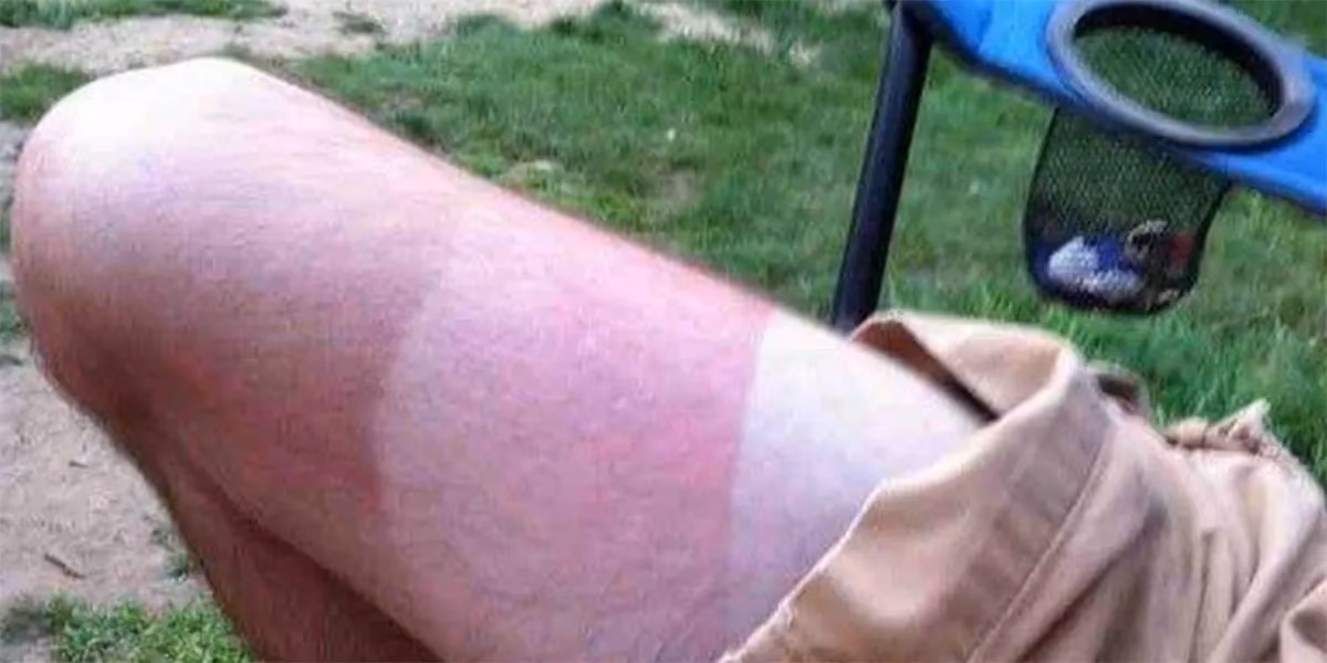 How do you treat a sunburn?